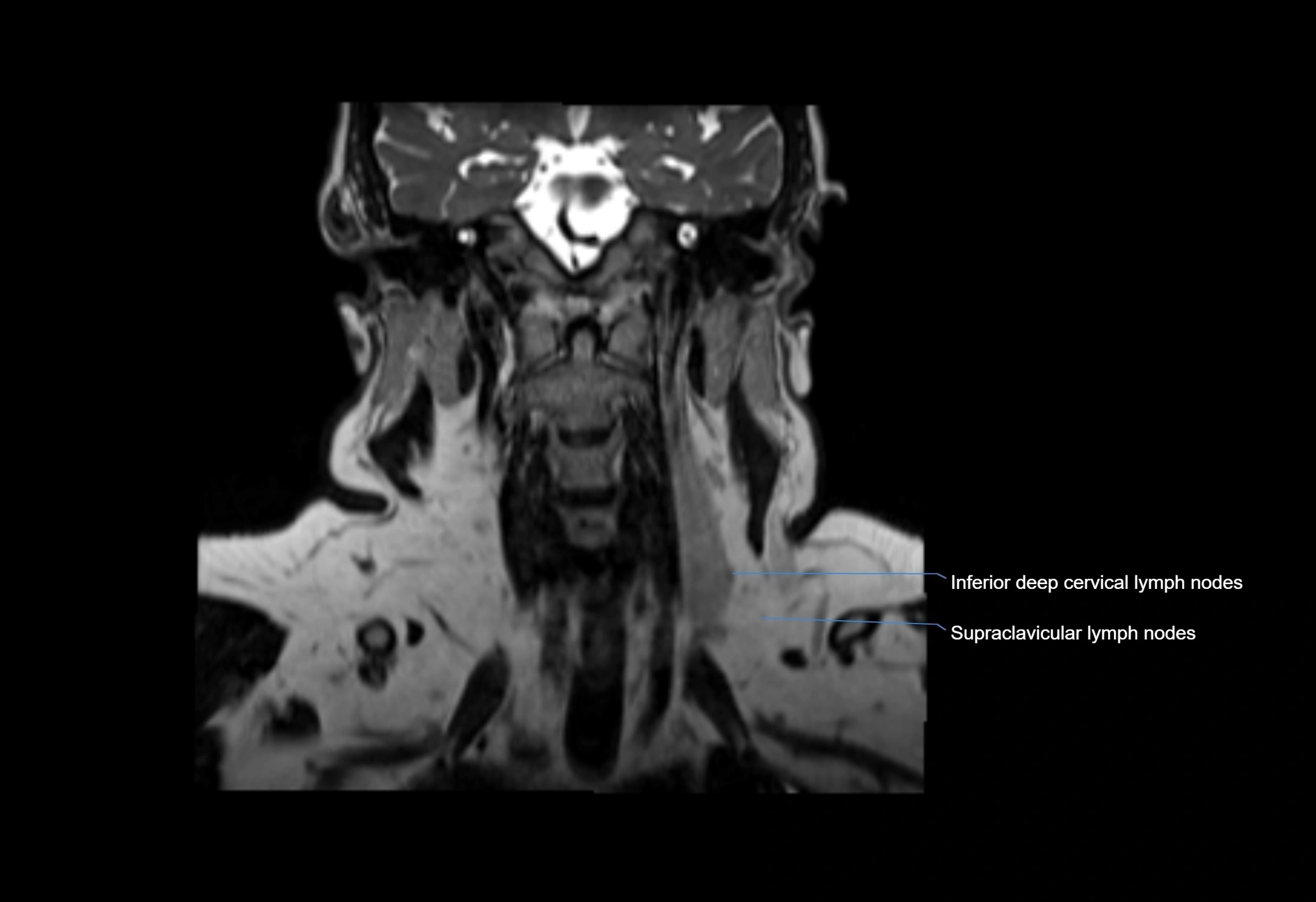Neck coronal lymph node cross sectional MRI anatomy 3T MRI  image-img-00001-00033.webp